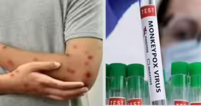 First monkeypox case